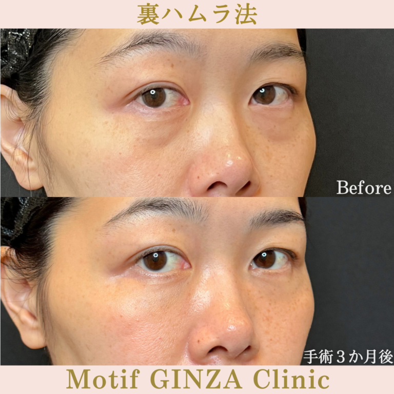 裏ハムラ法（手術3か月）の写真2