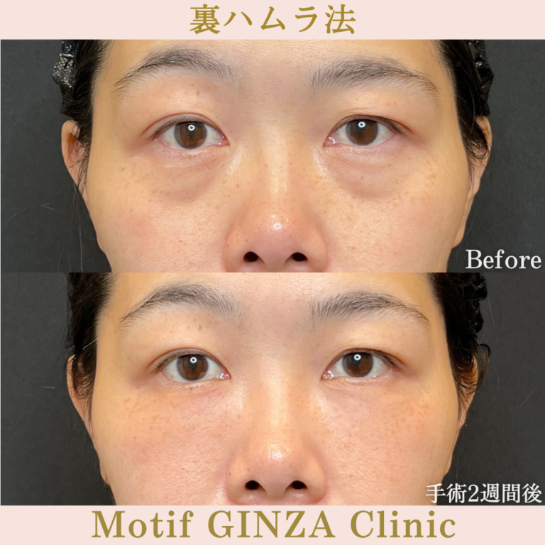 裏ハムラ法(手術1か月)の写真3