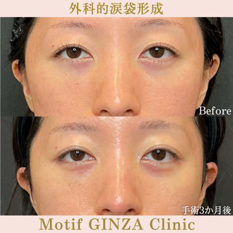 外科的涙袋形成術（手術3か月）