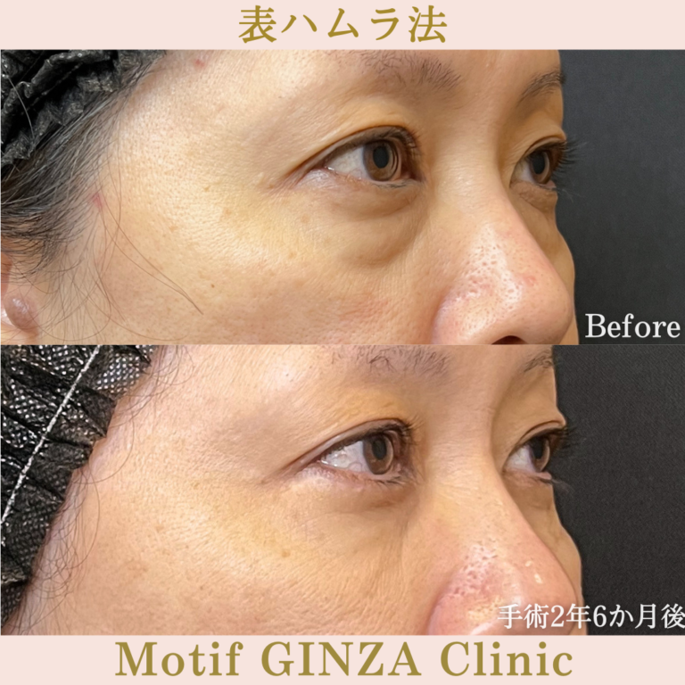 切開式下眼瞼たるみ取り（手術2年6か月）の写真2