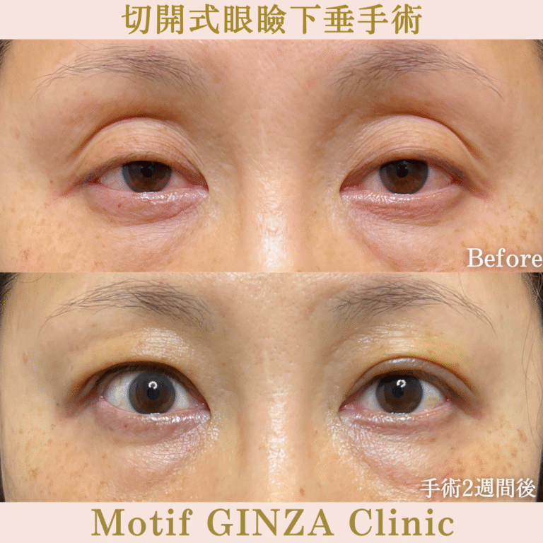 切開式眼瞼下垂手術（手術６ヶ月）の写真5
