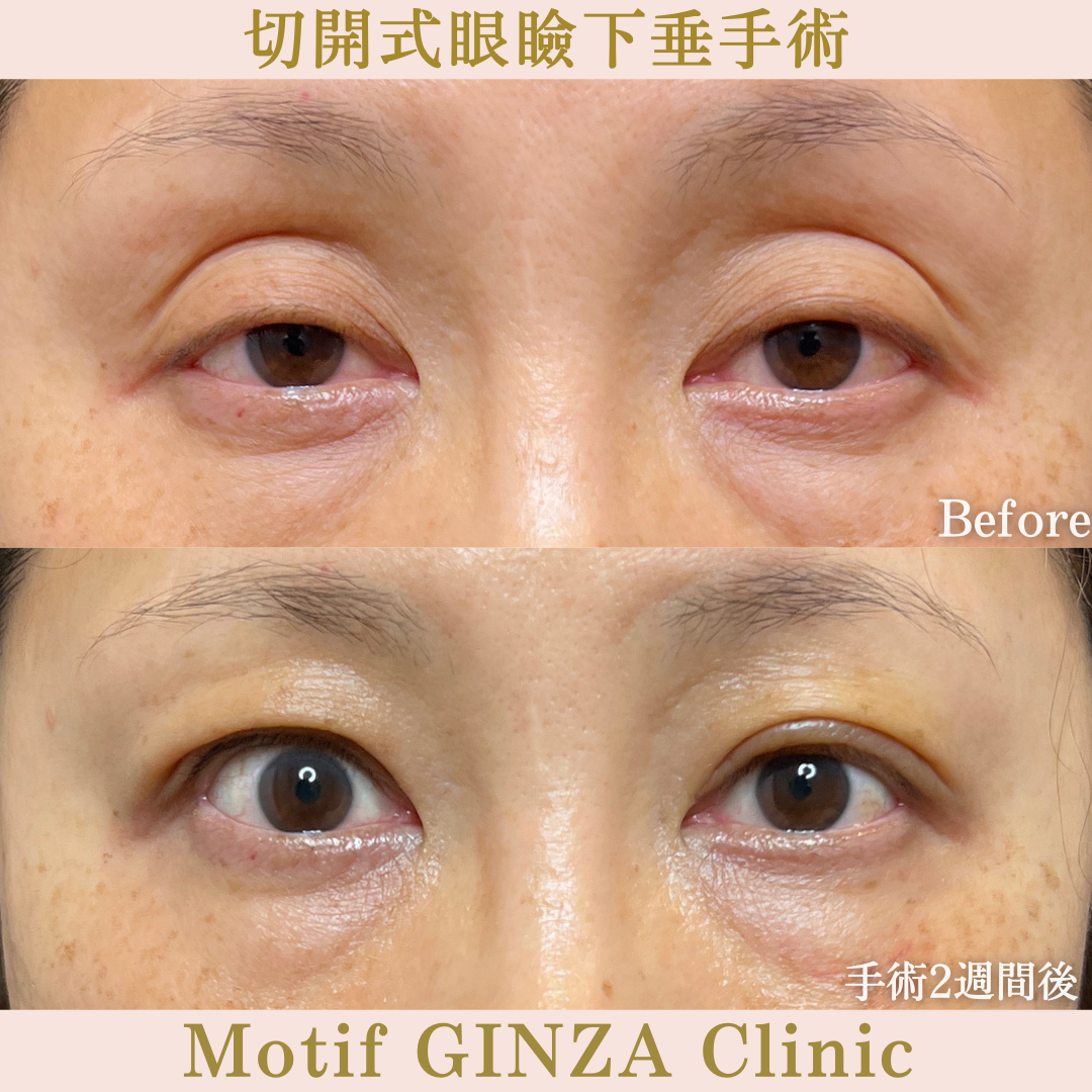 切開式眼瞼下垂手術（手術６ヶ月）の写真5