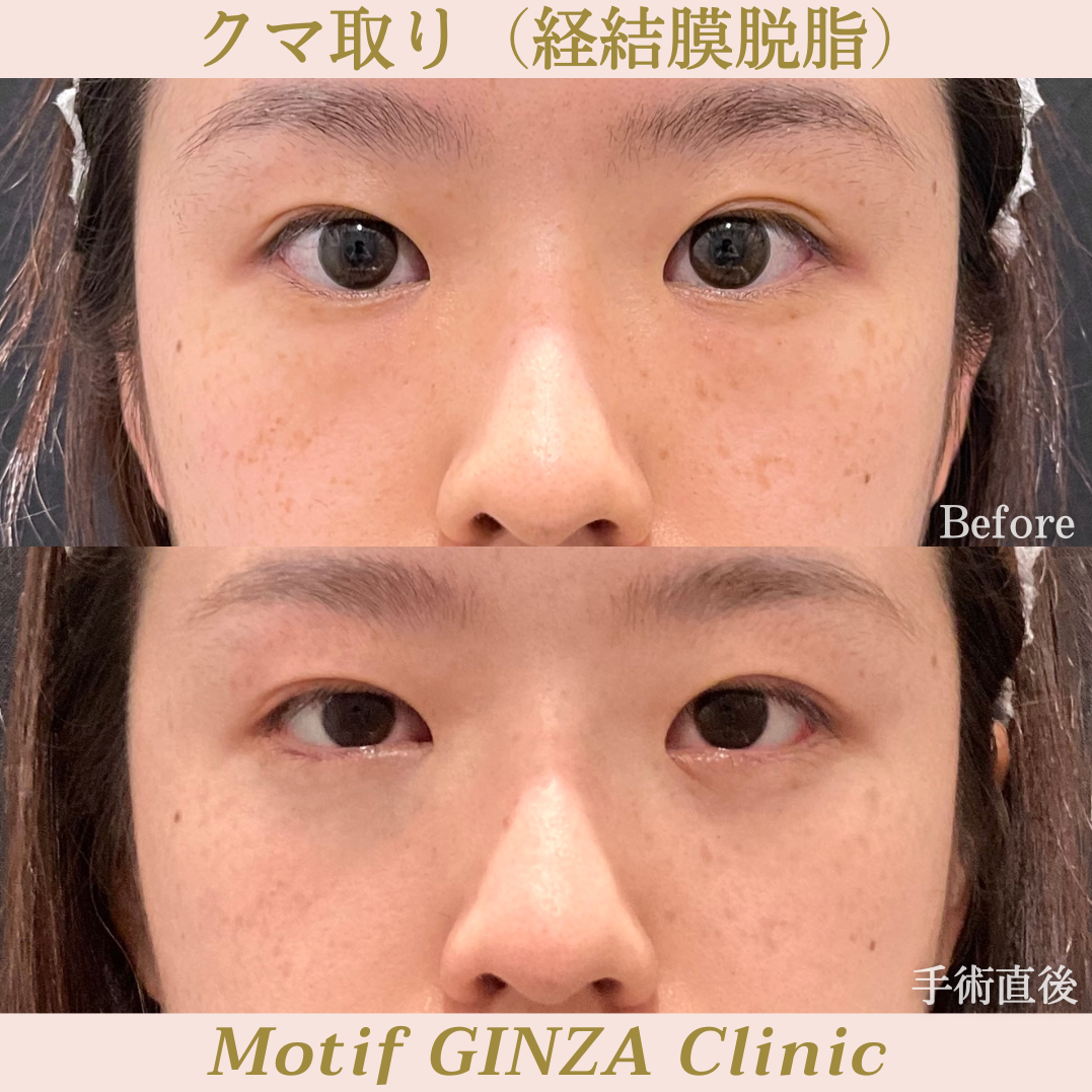 経結膜脱脂（手術１ヶ月）の写真4