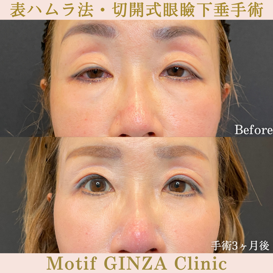 表ハムラ法・切開式眼瞼下垂手術(手術6ヶ月)の写真2