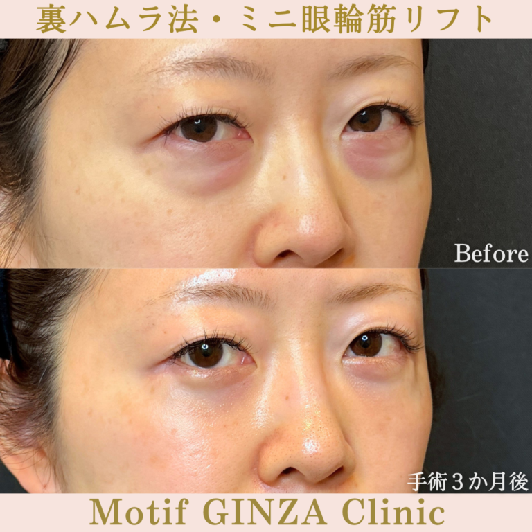 裏ハムラ法・ミニ眼輪筋リフト（手術3か月）の写真2