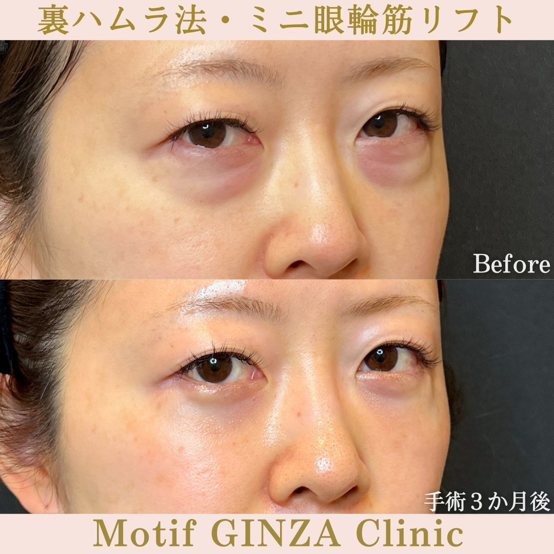 裏ハムラ法・ミニ眼輪筋リフト（手術6か月）の写真4