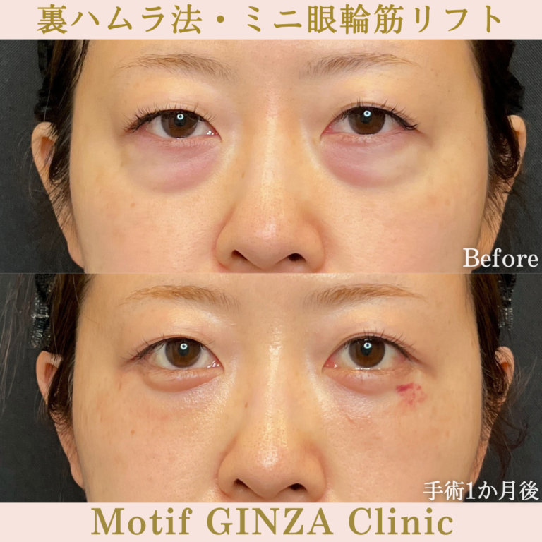 裏ハムラ法・ミニ眼輪筋リフト（手術1か月）