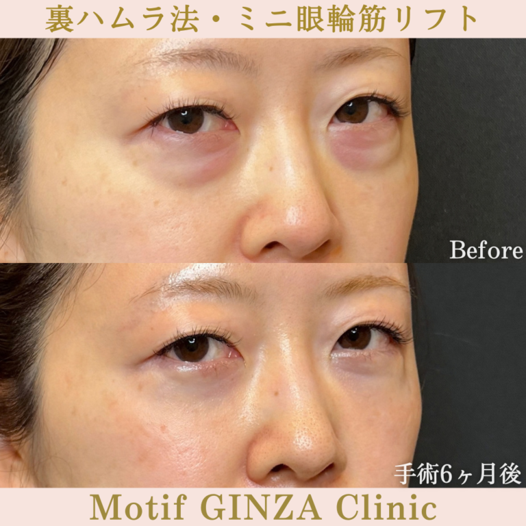 裏ハムラ法・ミニ眼輪筋リフト（手術6か月）の写真2