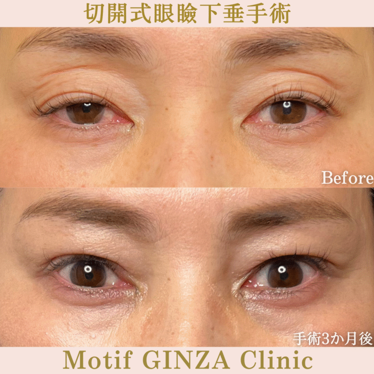 切開式眼瞼下垂手術（手術６か月）の写真3