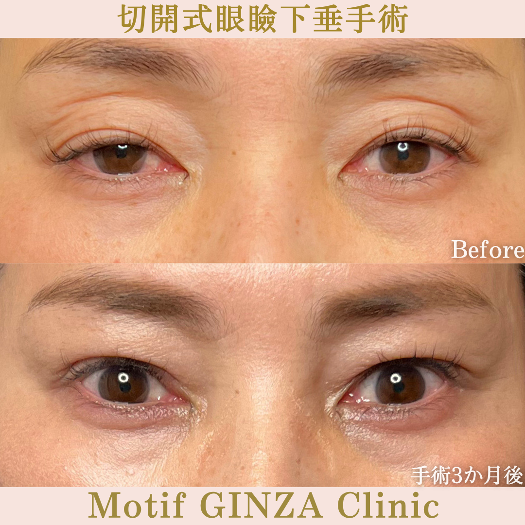 切開式眼瞼下垂手術（手術６か月）の写真3