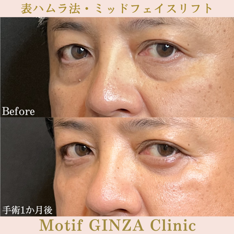 表ハムラ法・ミッドフェイスリフト（手術6か月）の写真6
