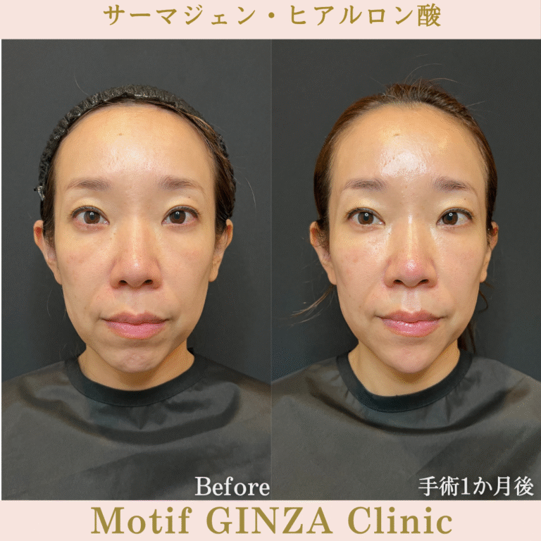 サーマジェン・ヒアルロン酸（手術１か月）の写真2
