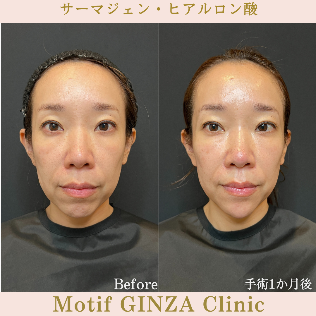 サーマジェン・ヒアルロン酸（手術１か月）の写真2