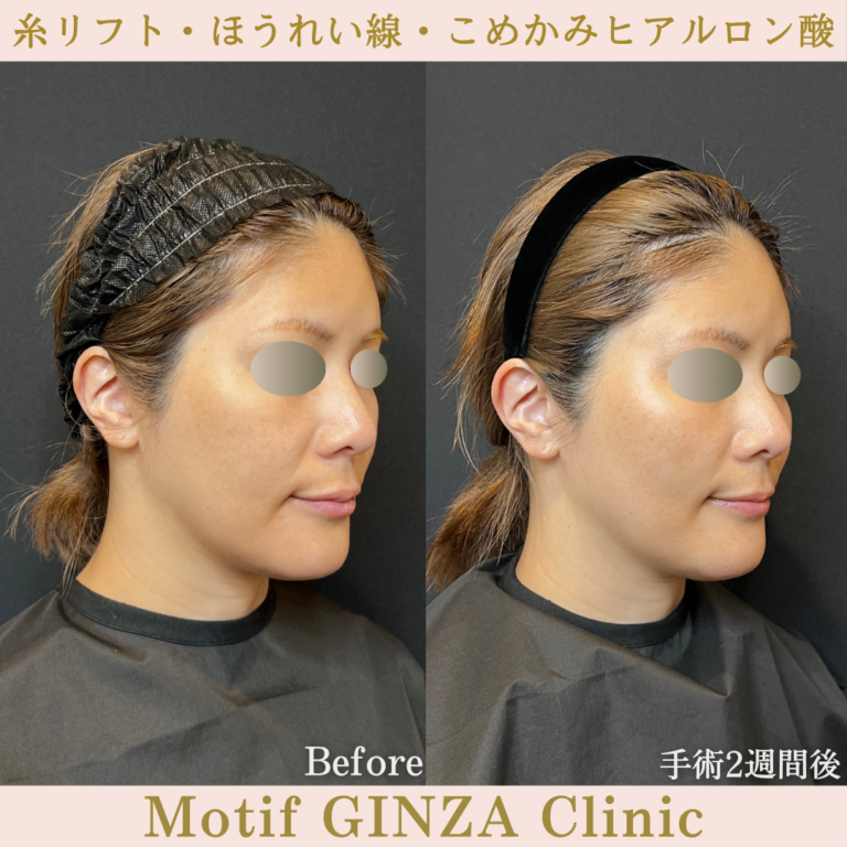 糸リフト・ほうれい線・こめかみヒアルロン酸(手術1か月)の写真4