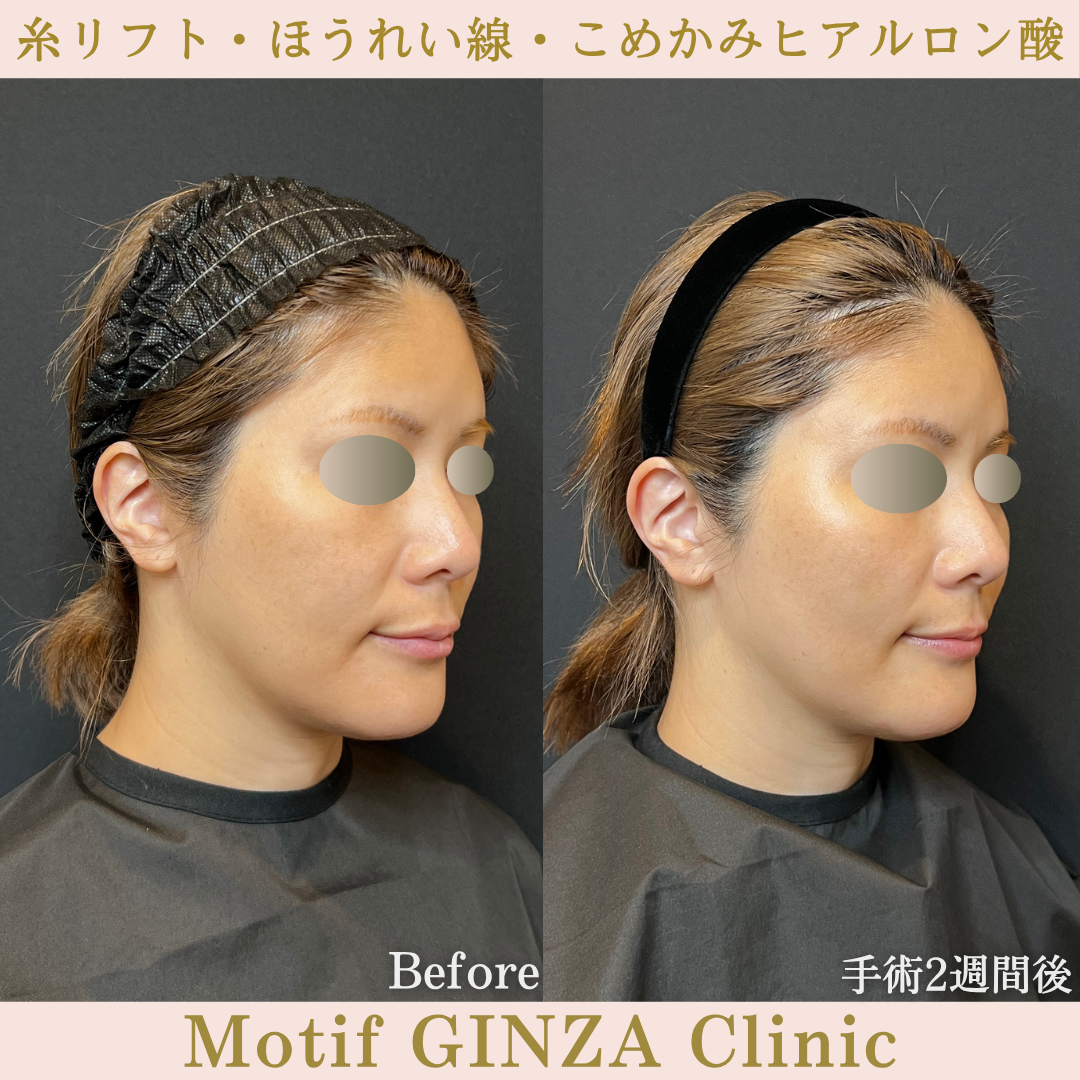 糸リフト・ほうれい線・こめかみヒアルロン酸（手術1か月）の写真4