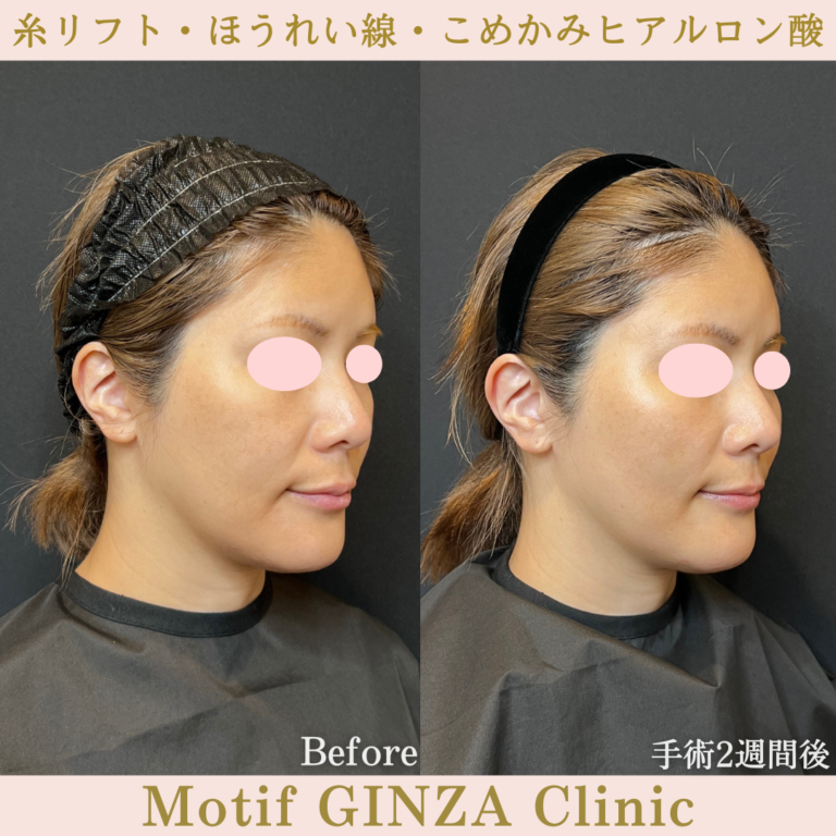 糸リフト・ほうれい線・こめかみヒアルロン酸（手術1か月）の写真4