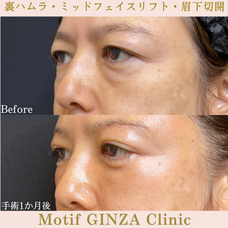 裏ハムラ法・ミッドフェイスリフト・眉下切開（手術６か月）の写真6