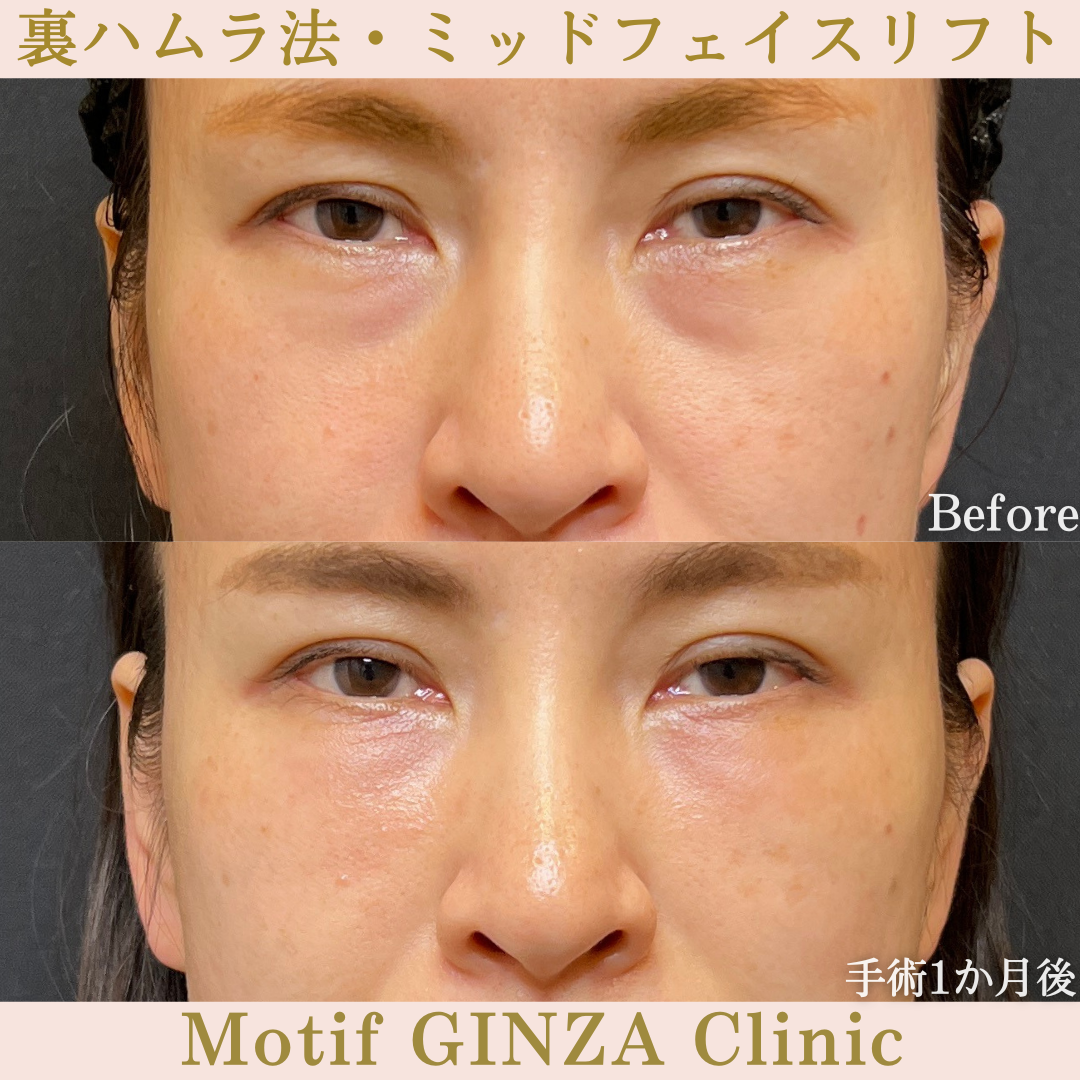 裏ハムラ法・ミッドフェイスリフト（手術１年）の写真5