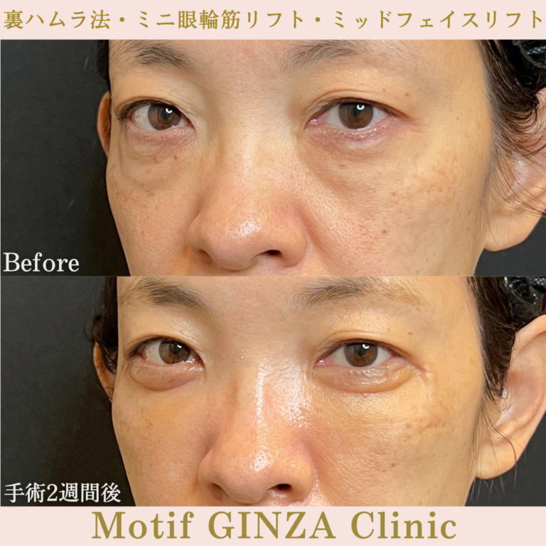 裏ハムラ法・ミニ眼輪筋リフト・ミッドフェイスリフト（手術３か月）の写真6