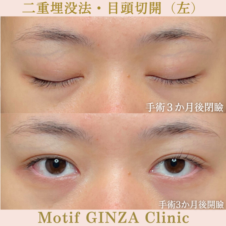 二重埋没法・目頭切開（手術３か月）の写真2