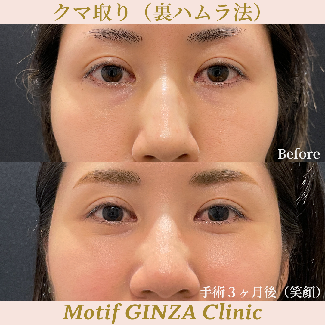 裏ハムラ法（手術３ヶ月）の写真