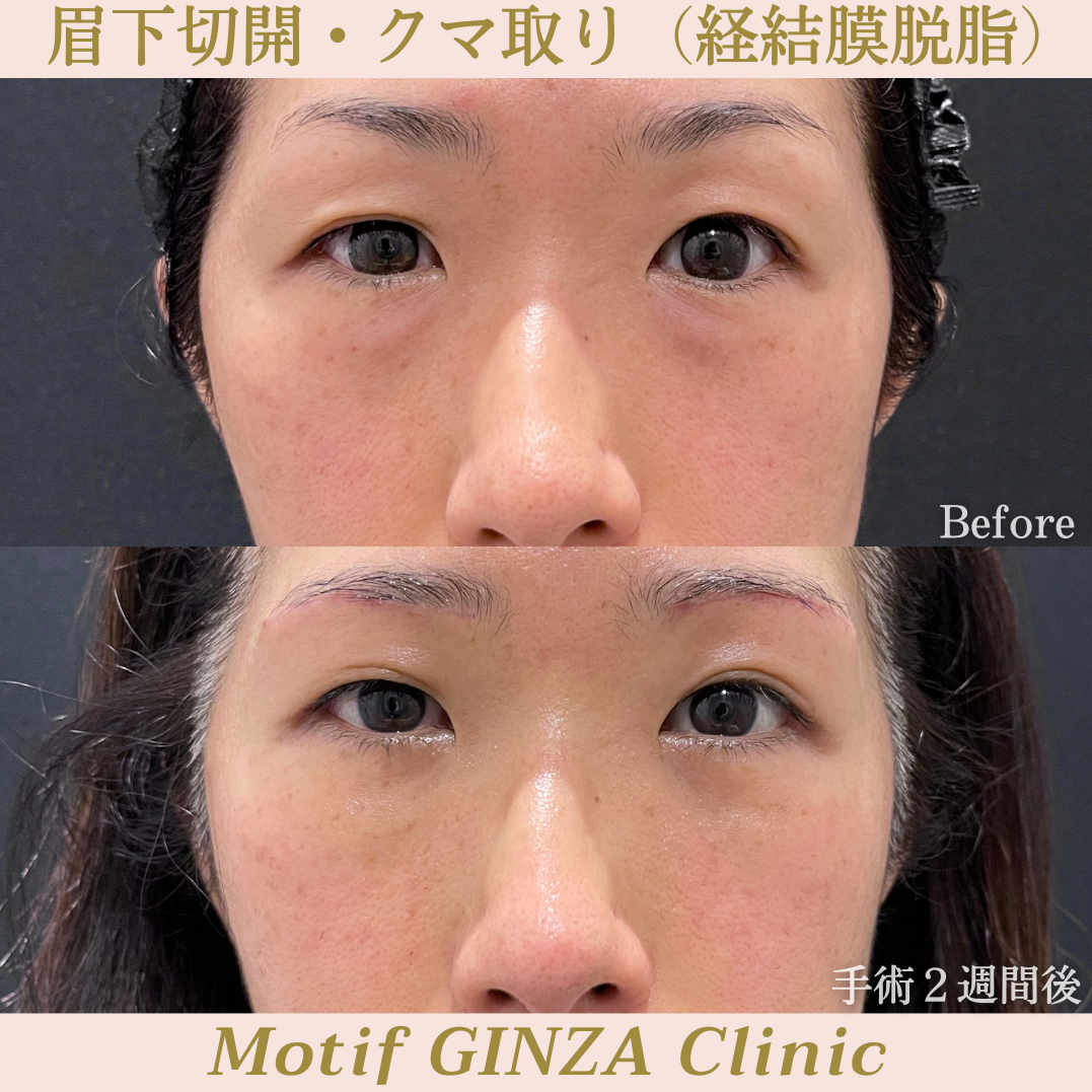 眉下切開・経結膜脱脂(手術3ヶ月)の写真4