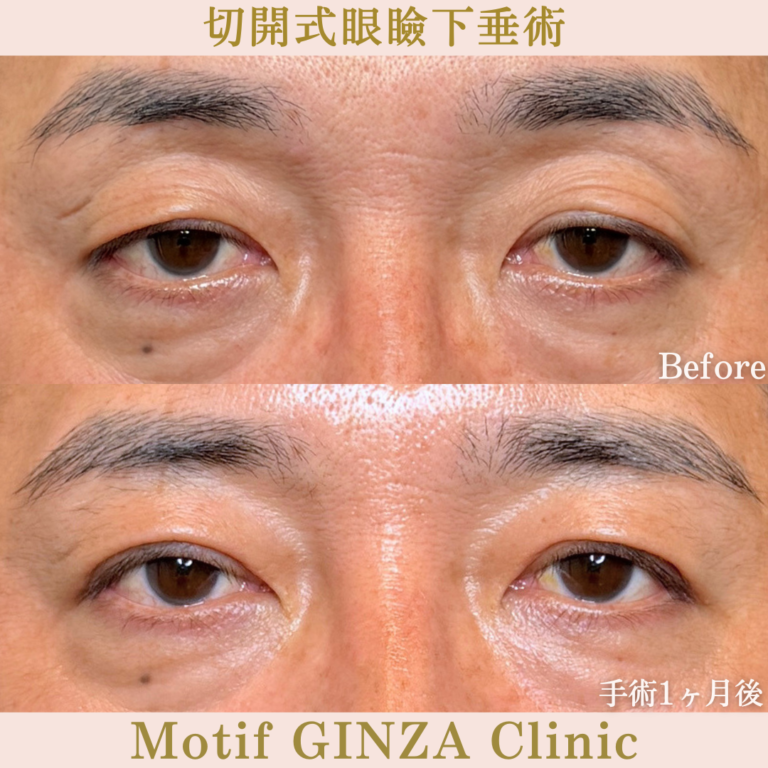 切開式眼瞼下垂手術(手術3か月)の写真3