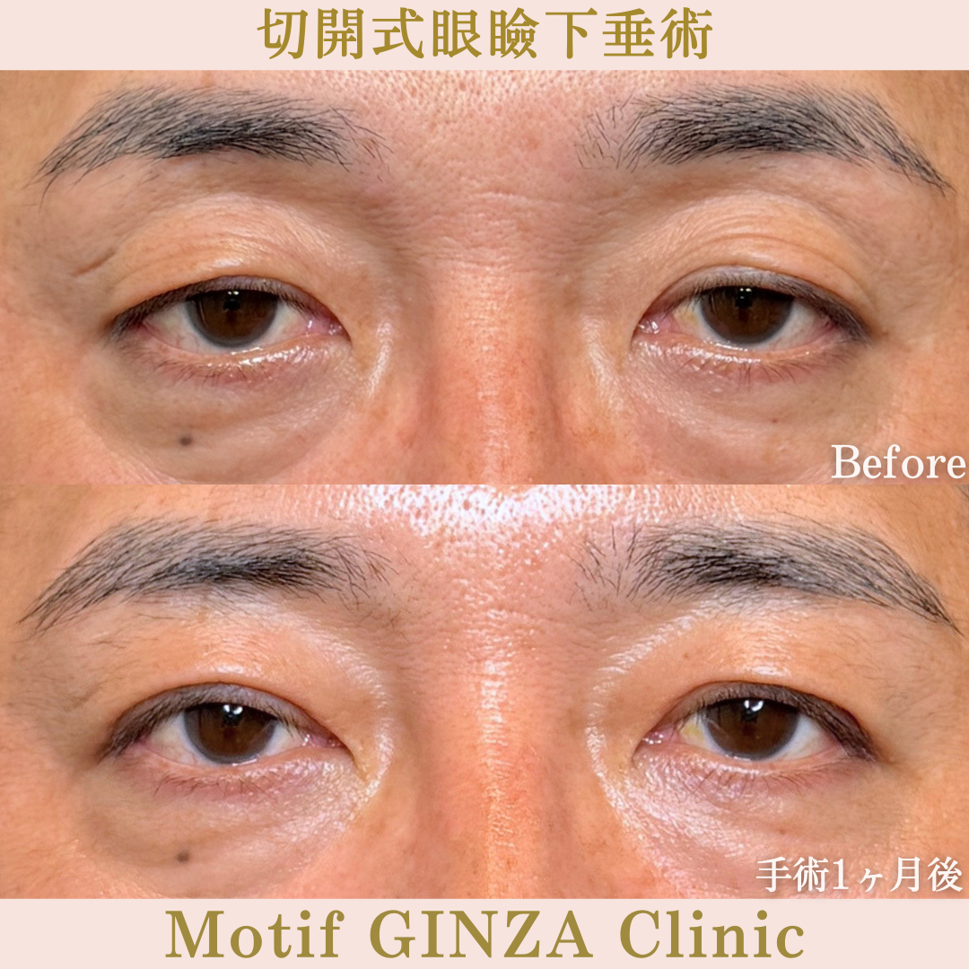 切開式眼瞼下垂手術(手術3か月)の写真3