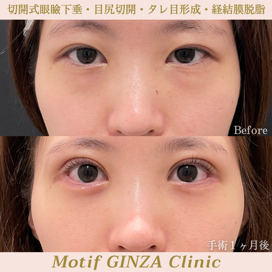 目元複合切開(手術3ヶ月)の写真3