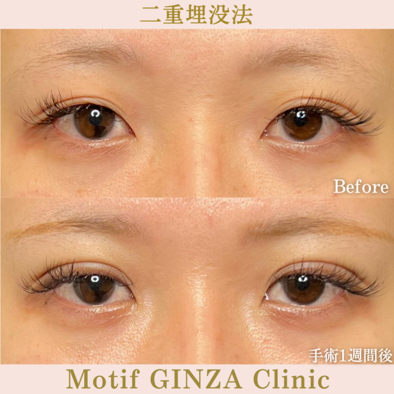 二重埋没法法（手術１か月）の写真2