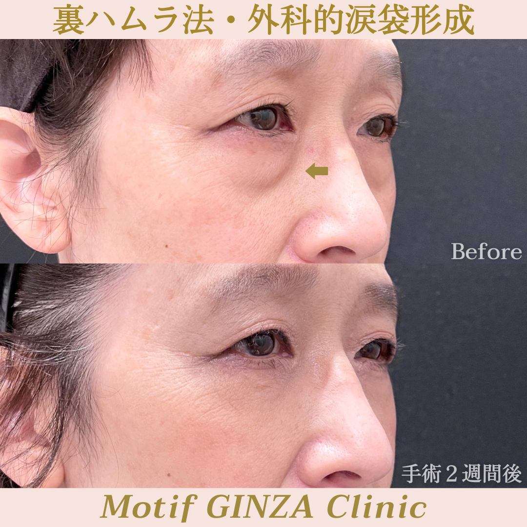 裏ハムラ法・外科的涙袋形成(手術1ヶ月)の写真4