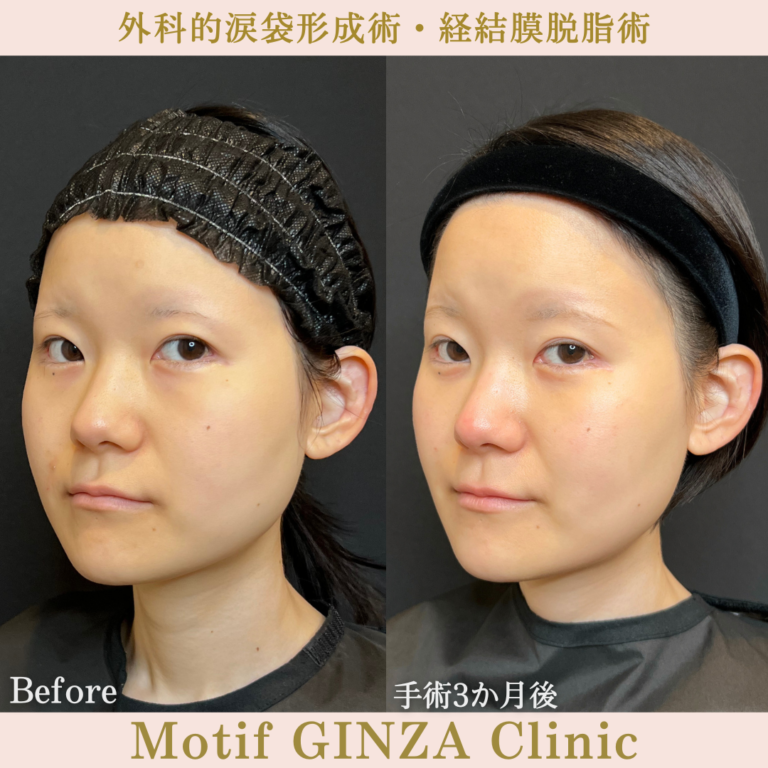 外科的涙袋形成術・経結膜脱脂術（手術３か月）の写真3