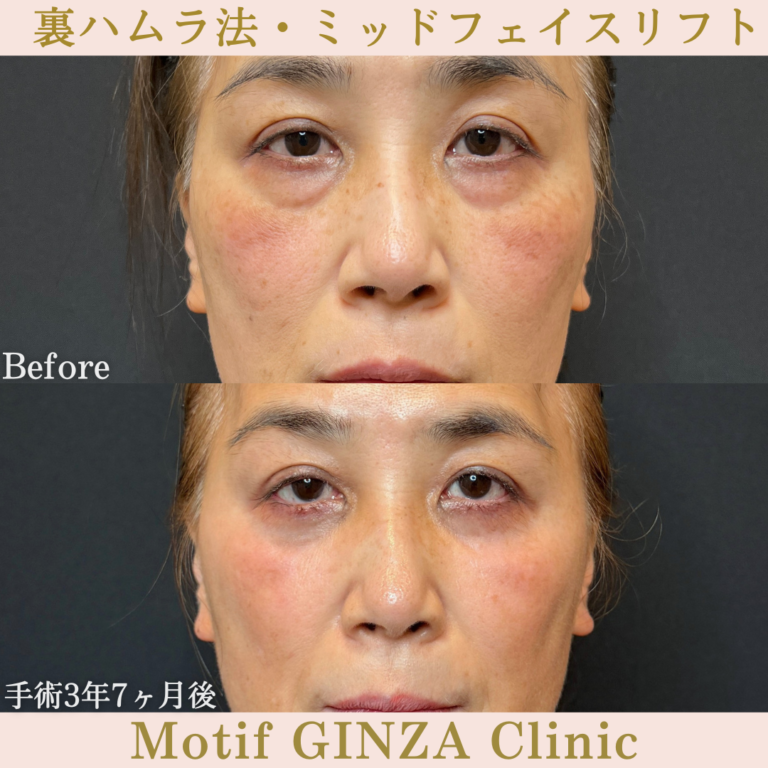 裏ハムラ法・ミッドフェイスリフト（手術3年7ヶ月）