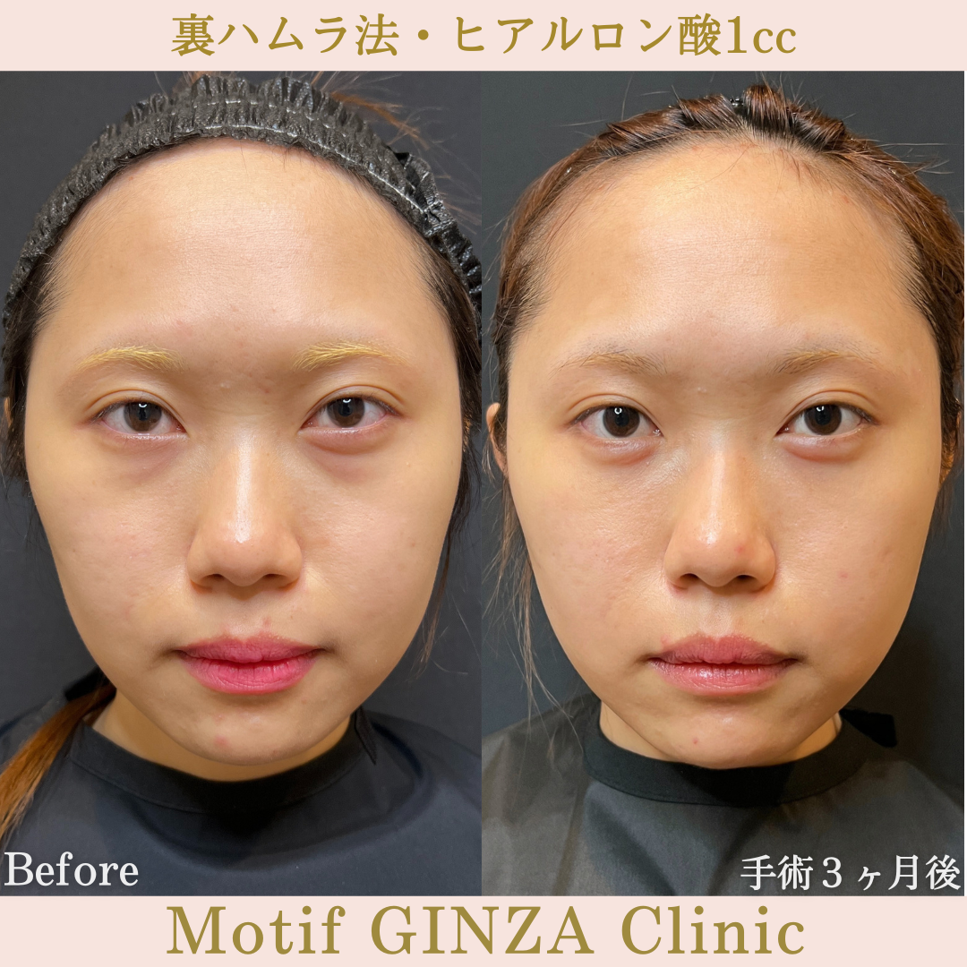 裏ハムラ法・ヒアルロン酸1cc（手術３ヶ月）の写真
