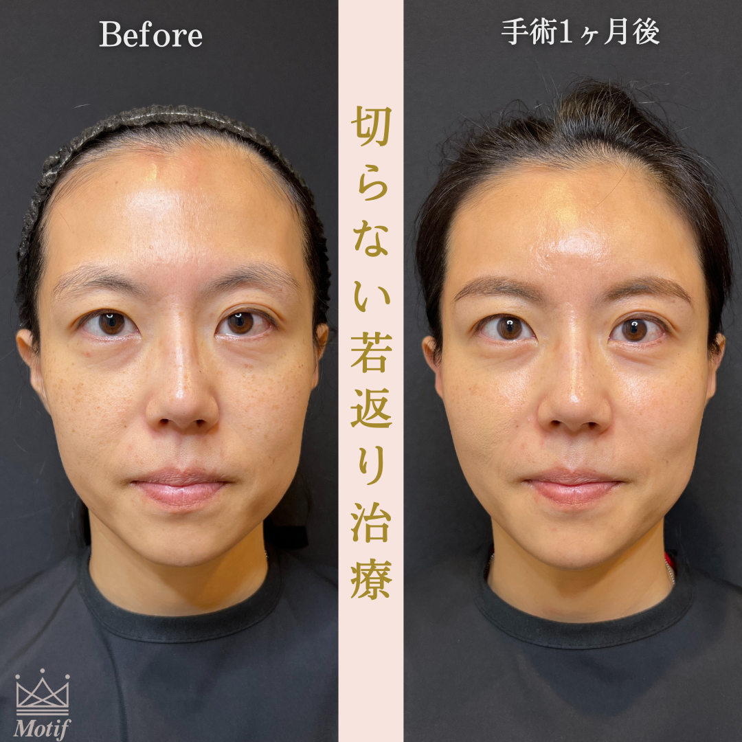 切らない若返り治療（手術１ヶ月）の写真