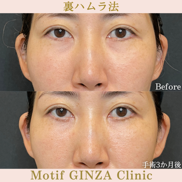 裏ハムラ法（手術３か月）