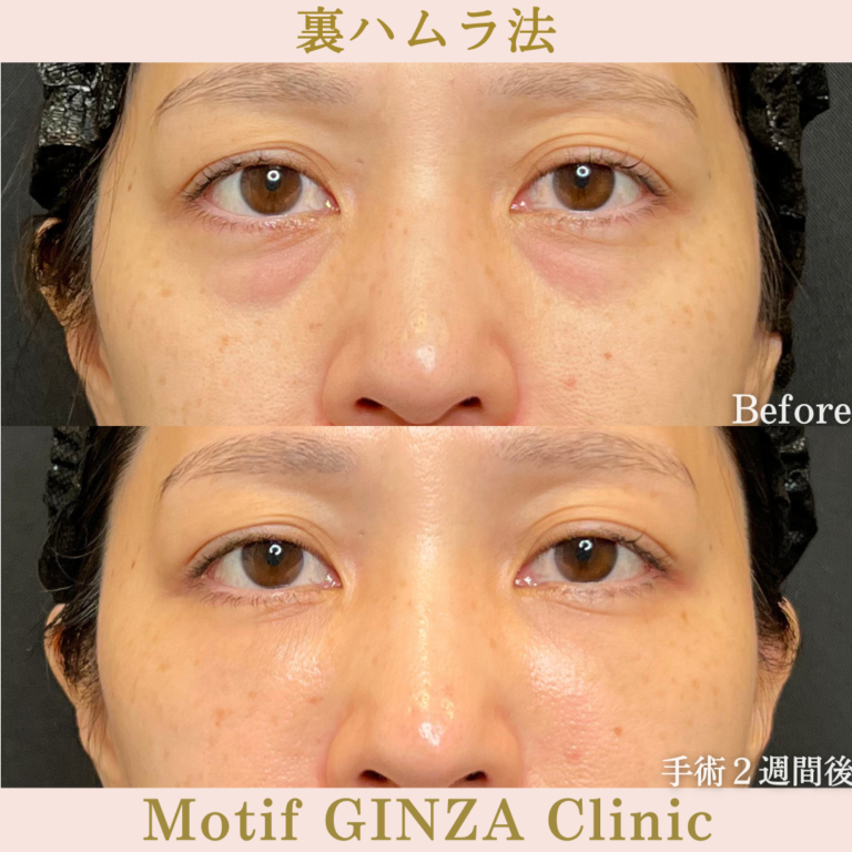 裏ハムラ法(手術1か月)の写真3