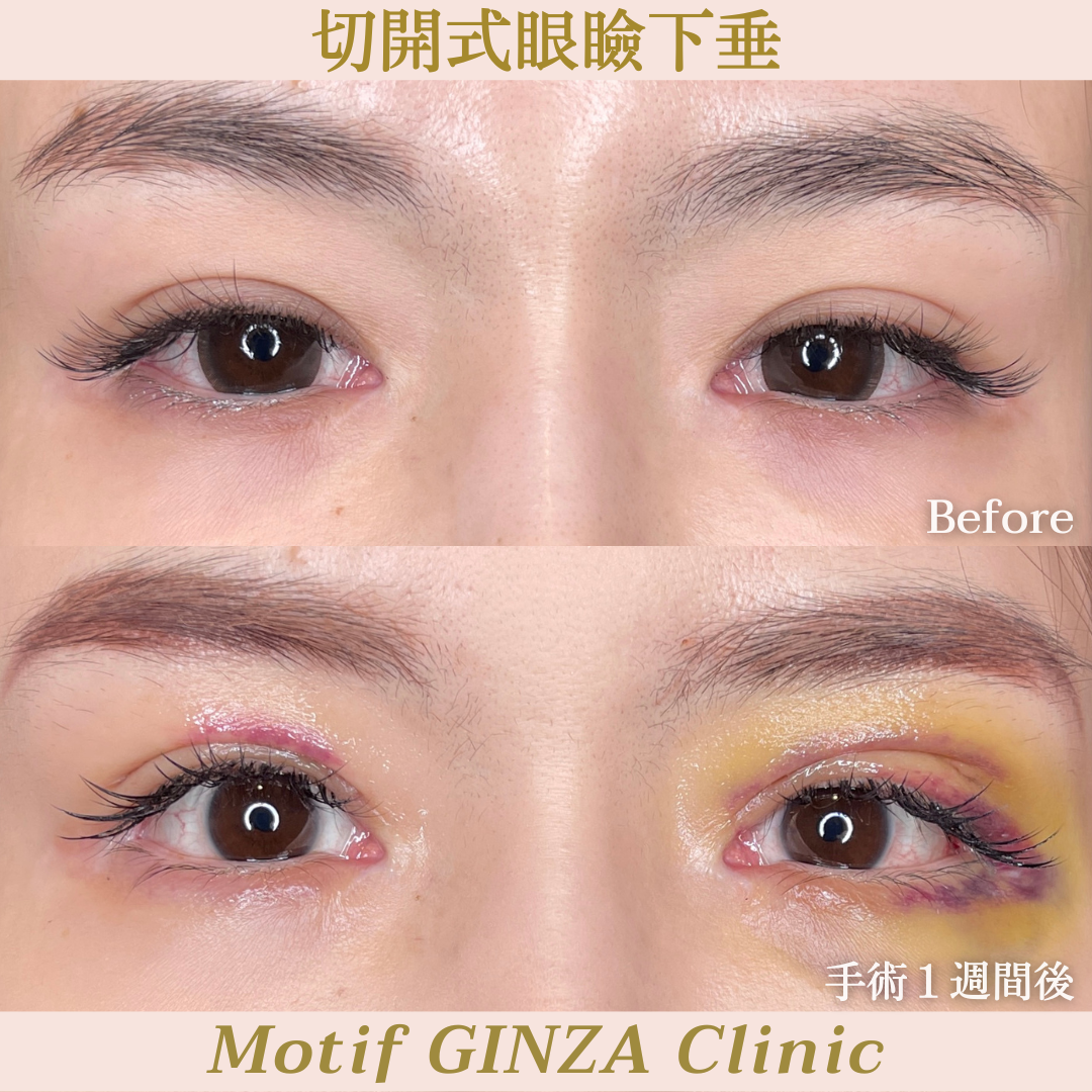 切開式眼瞼下垂手術(手術3ヶ月)の写真5