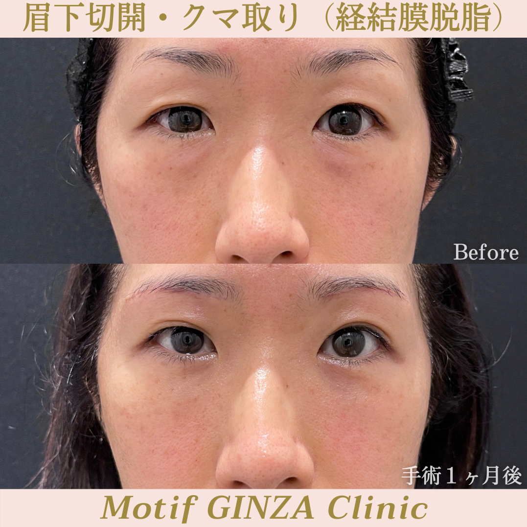 眉下切開・経結膜脱脂(手術3ヶ月)の写真3