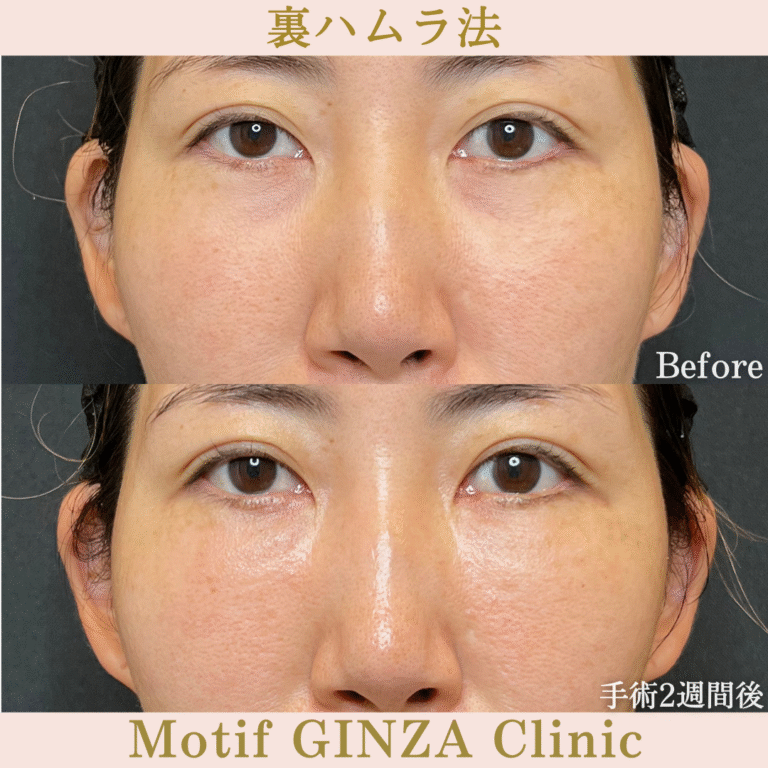 裏ハムラ法（手術３か月）の写真5