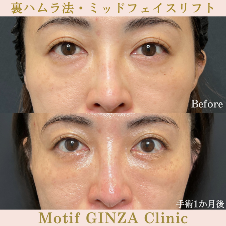 裏ハムラ法・ミッドフェイスリフト(手術3か月)の写真3