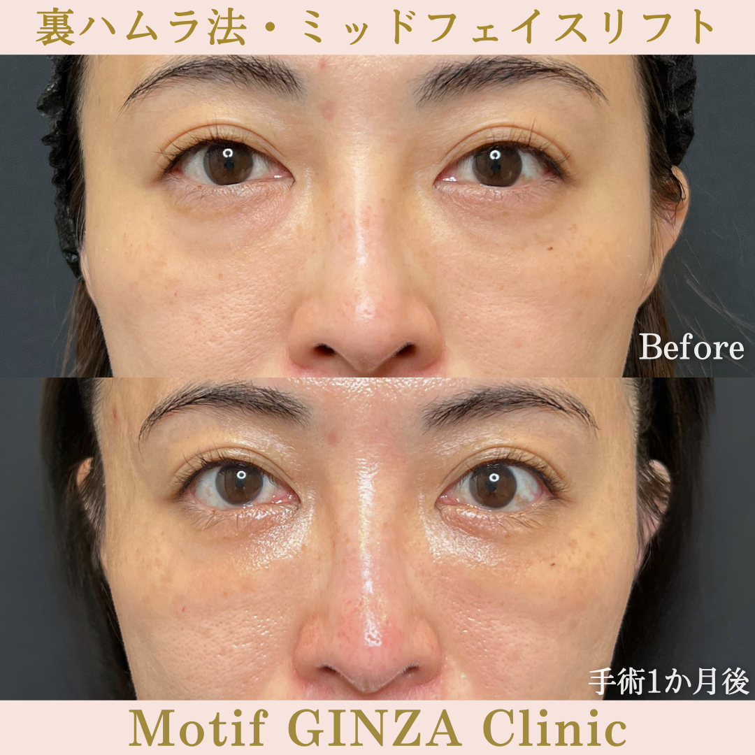 裏ハムラ法・ミッドフェイスリフト（手術３か月）の写真3