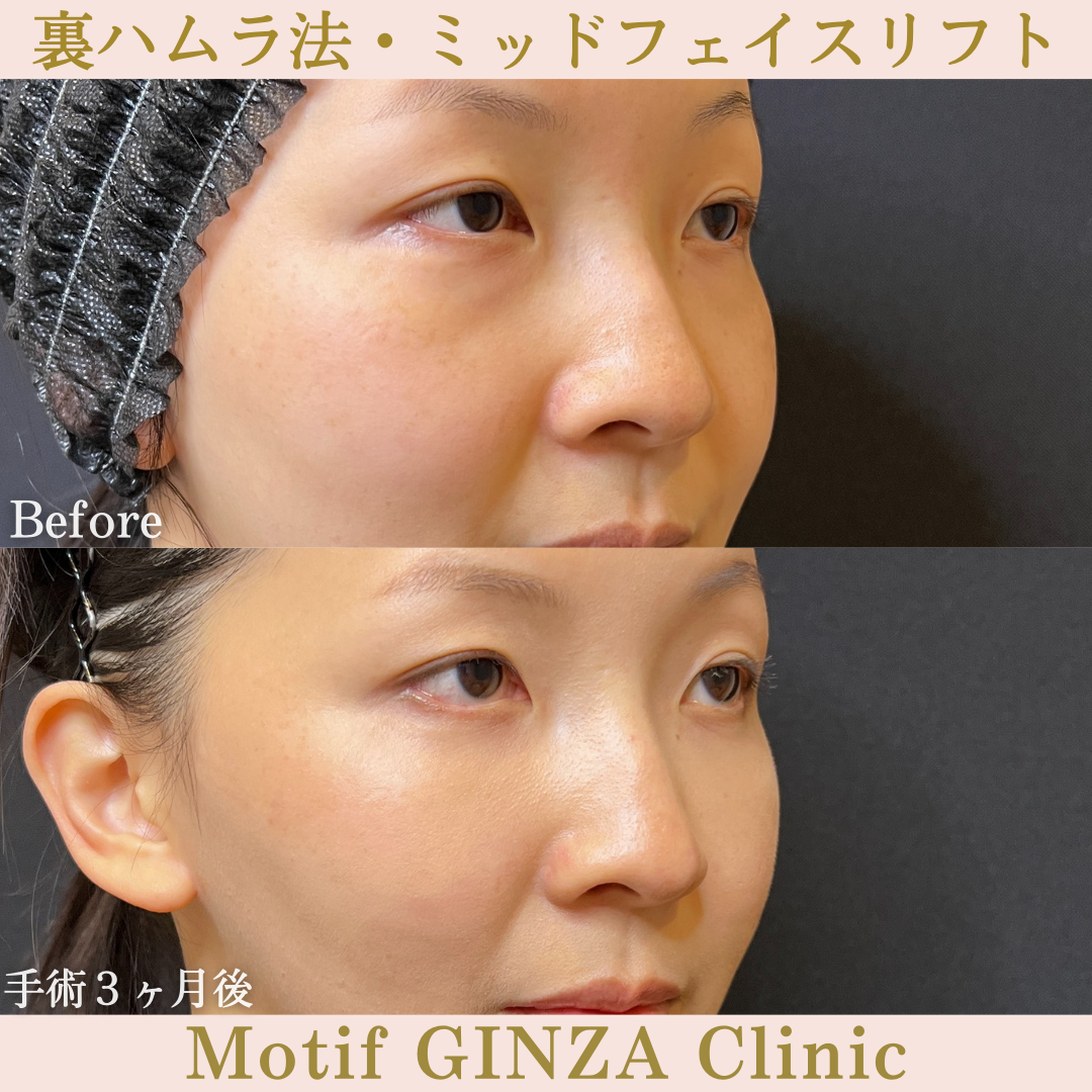 裏ハムラ法・ミッドフェイスリフト（手術３ヶ月）の写真2