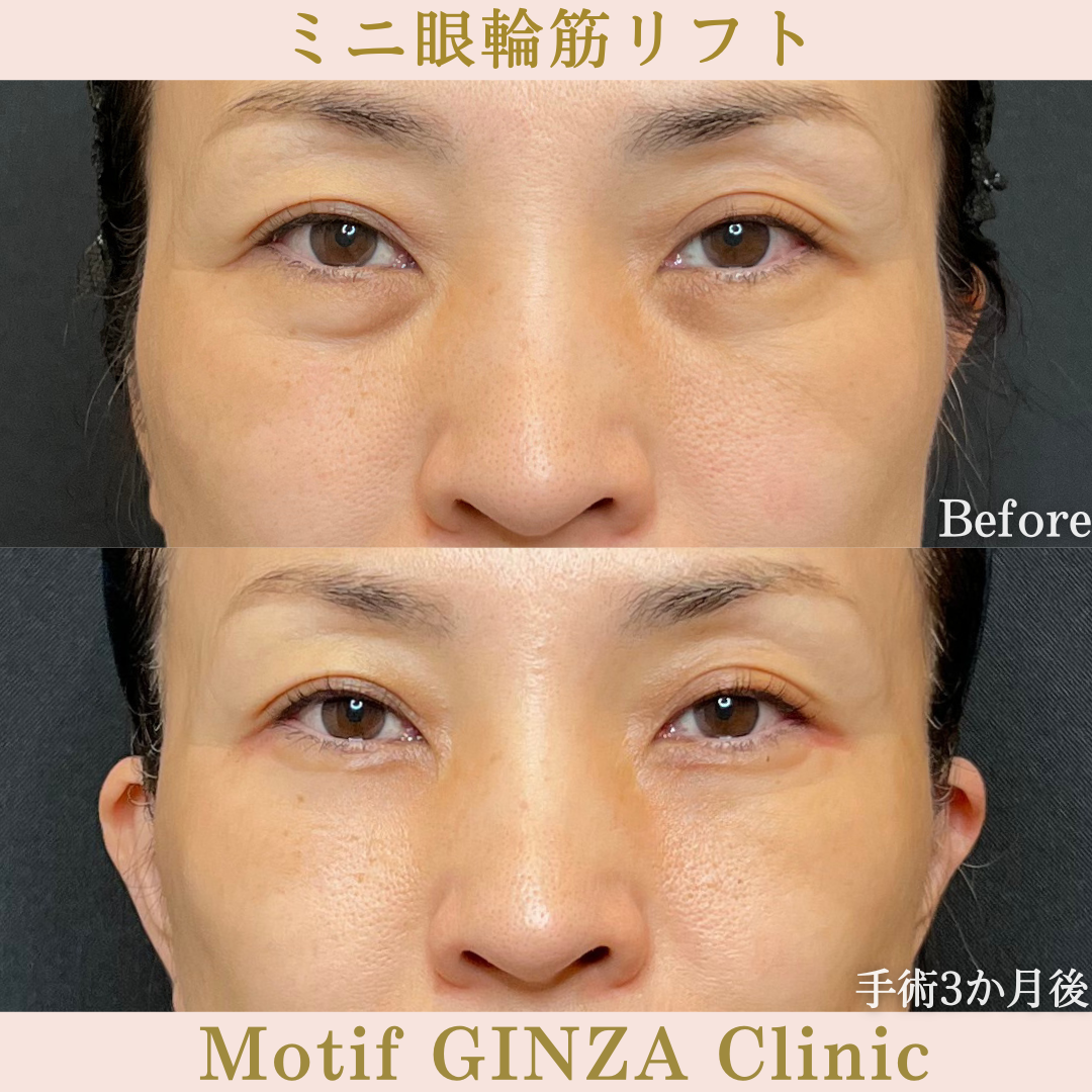 ミニ眼輪筋リフト（手術３か月）の写真