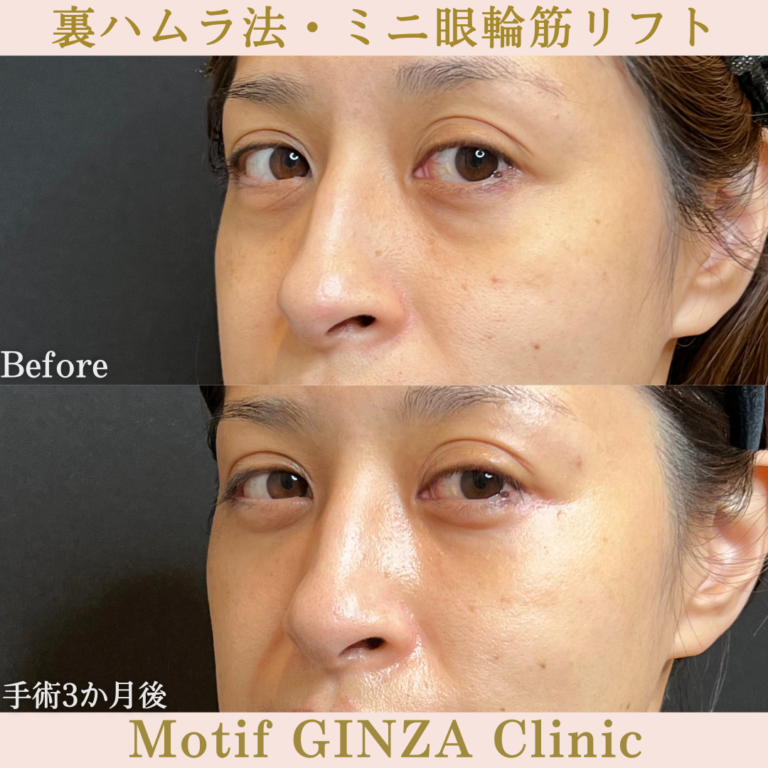 裏ハムラ法・ミニ眼輪筋リフト（手術３か月）の写真2
