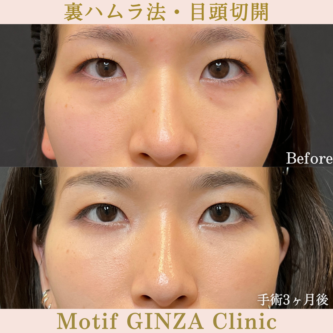 裏ハムラ法・目頭切開(手術6か月)の写真3
