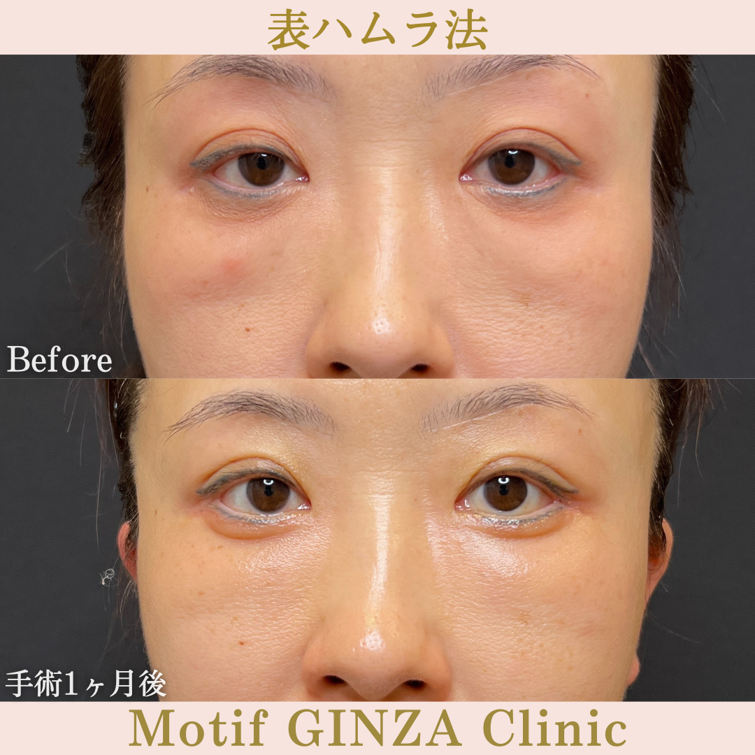 切開式下眼瞼たるみ取り(手術6ヶ月)の写真3