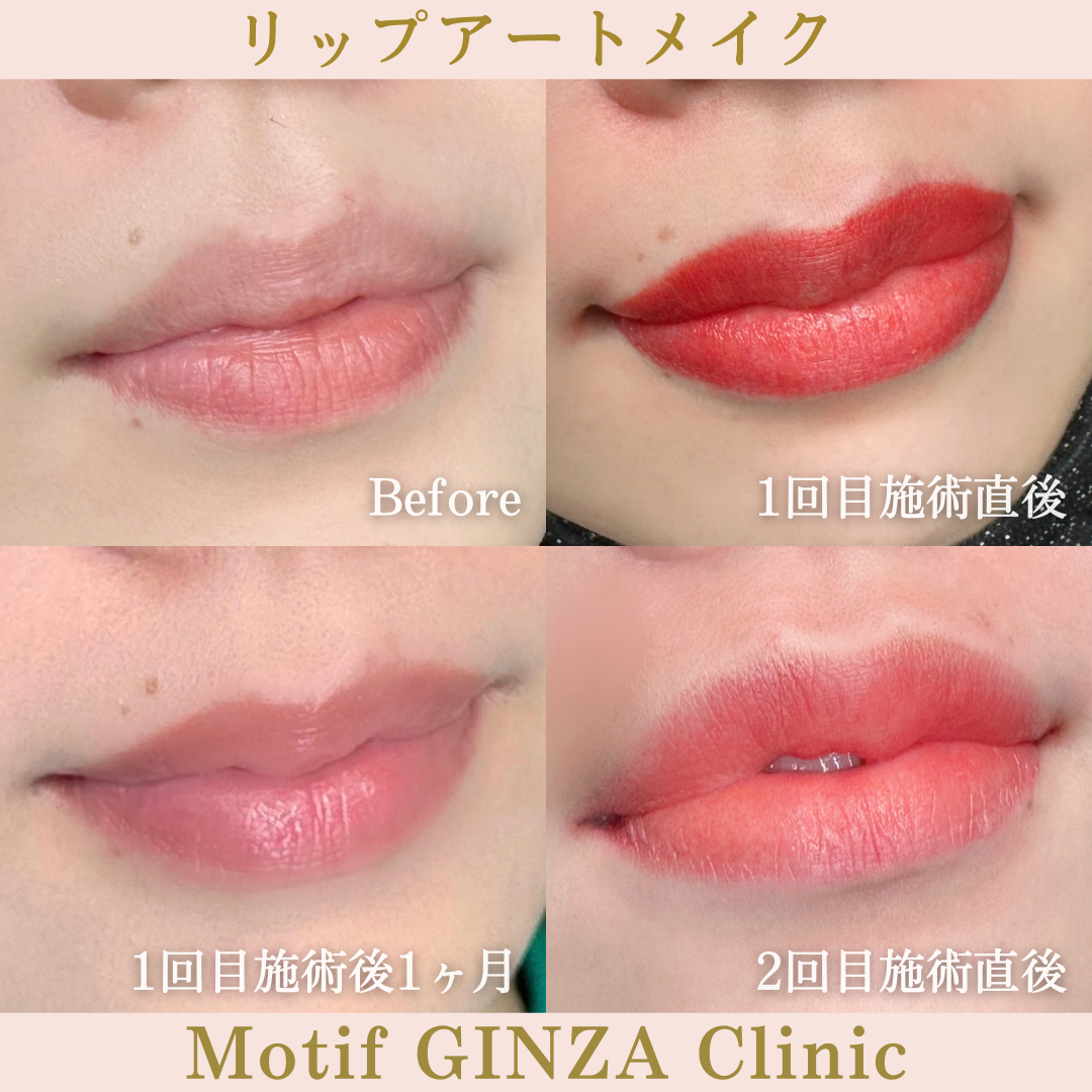 リップアートメイク（手術２ヶ月後）の写真
