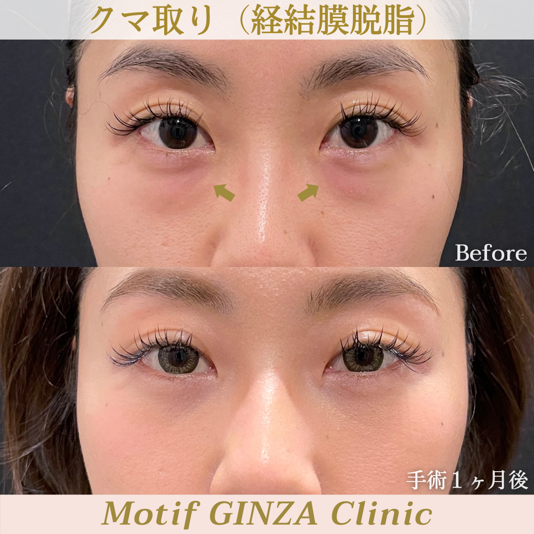 経結膜脱脂(手術1ヶ月)の写真1