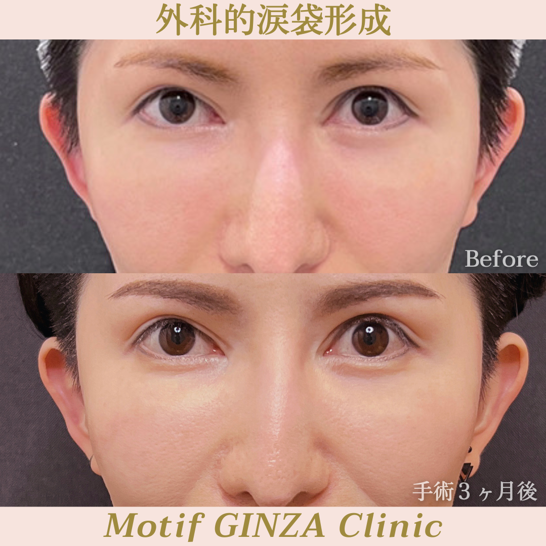 外科的涙袋形成（手術３ヶ月）の写真